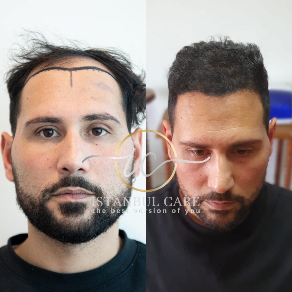 Explore our About Us page dedicated to Hair Transplants in Cancun. Discover how we're redefining hair restoration with advanced techniques.