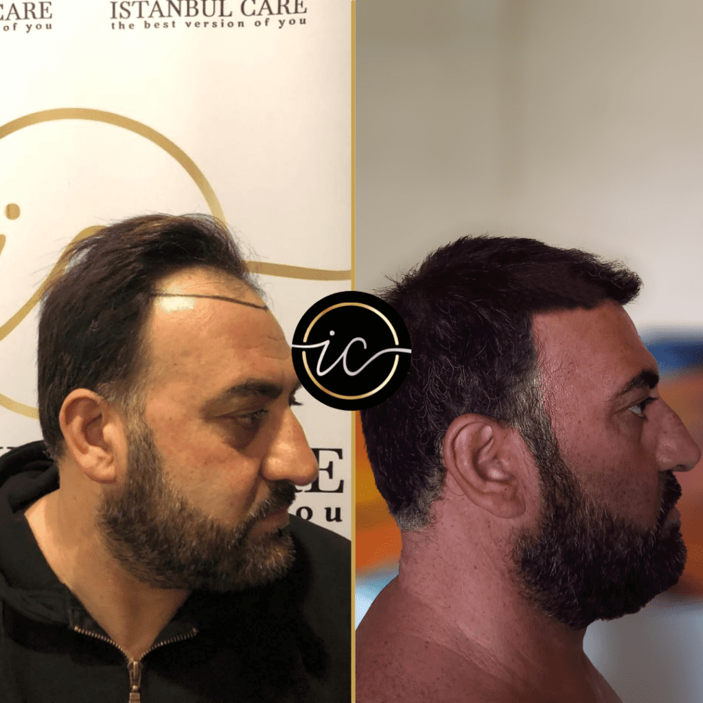 Explore our About Us page dedicated to Hair Transplants in Cancun. Discover how we're redefining hair restoration with advanced techniques.