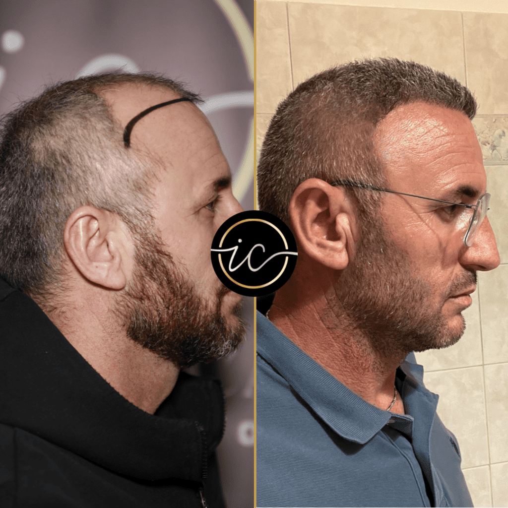 Before After Hair Transplant Photos